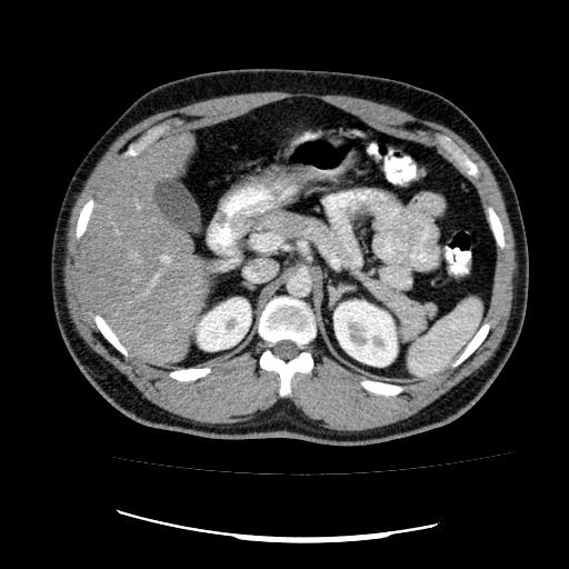 File:Appendicitis with diverticulosis (Radiopaedia 47693-52383 Axial C+ 41).jpg
