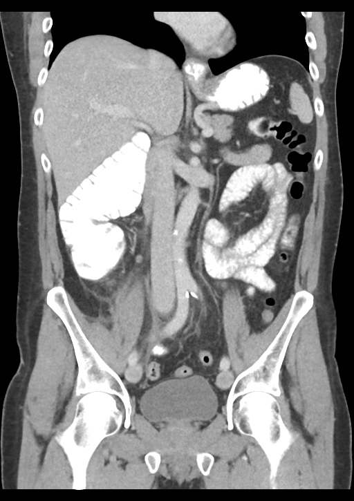 Appendicitis with thickening of the terminal ileum (Radiopaedia 42432-45550 B 30).png