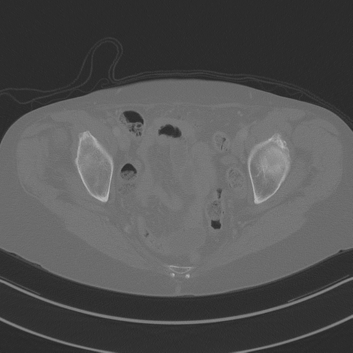 April fools' 2019- calcified peritoneal arachnoidosis (Radiopaedia 67273-76636 Axial bone window 49).png