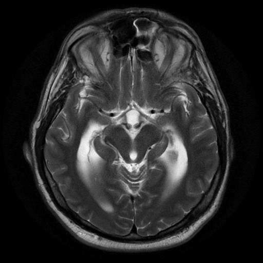 File:Aqueduct stenosis with corpus callosum hypoattenuation post shunting (Radiopaedia 37212-38969 Axial T2 8).png