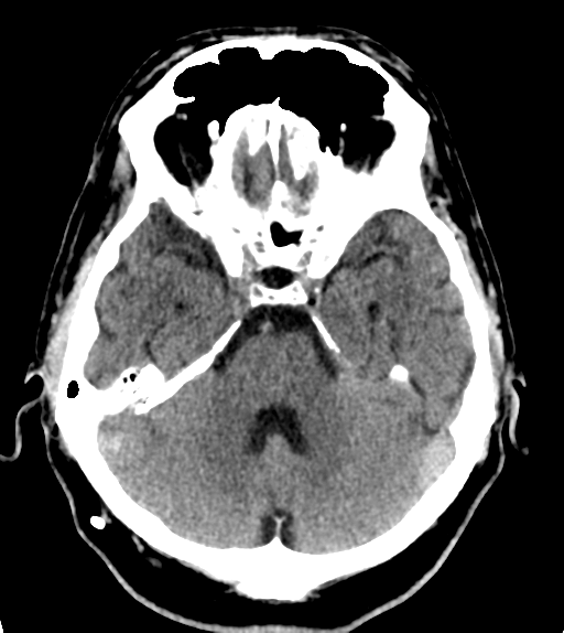 File:Aqueduct stenosis with corpus callosum hypoattenuation post shunting (Radiopaedia 37212-38971 Axial non-contrast 8).png