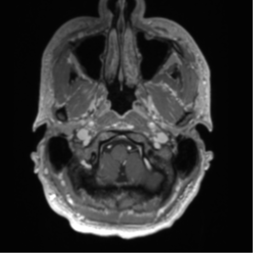 File:Arachnoid cyst with subdural hematoma (Radiopaedia 85892-101743 Axial T1 C+ 12).png