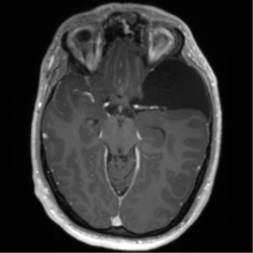 Arachnoid cyst with subdural hematoma (Radiopaedia 85892-101743 Axial T1 C+ 37).png