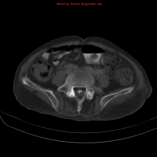 File:Arachnoiditis ossificans (Radiopaedia 51394-57136 Axial bone window 28).jpg