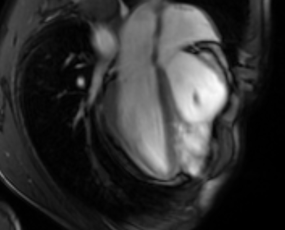Arrhythmogenic right ventricular cardiomyopathy (Radiopaedia 69564-79464 4ch cine 68).jpg