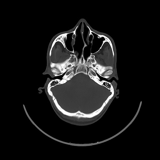Arrow injury to the brain (Radiopaedia 72101-82607 Axial bone window 56).jpg