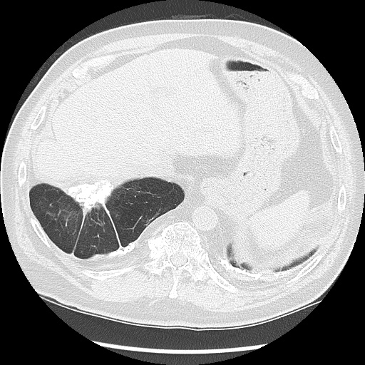 Asbestos-related pleural disease (Radiopaedia 74366-85250 Axial lung window 99).jpg