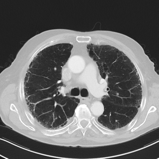 File:Asbestosis (Radiopaedia 56192-62864 Axial lung window 27).png