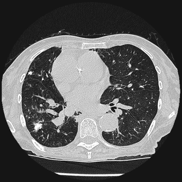 Aspergilloma (Radiopaedia 24458-24763 Axial lung window 37).jpg