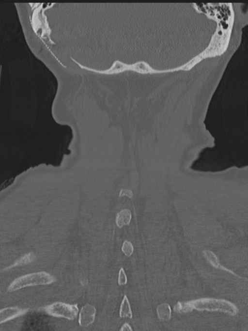 Atlanto-axial subluxation (Radiopaedia 36610-38176 Coronal bone window 45).png