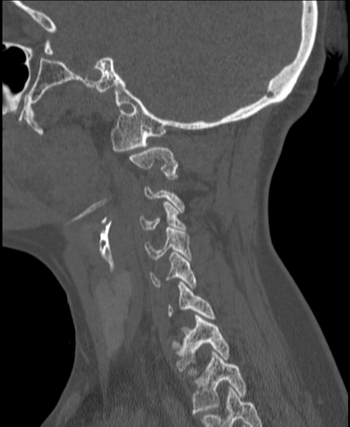 Atlanto-occipital assimilation with basilar invagination (Radiopaedia 70122-80188 Sagittal bone window 116).jpg