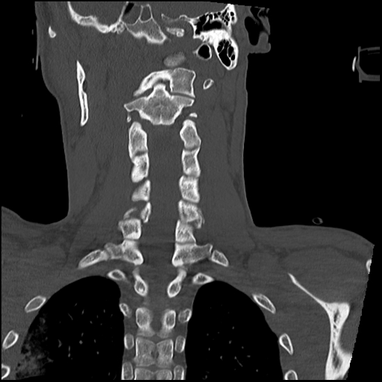 Atlanto-occipital dissociation (Traynelis type 1), C2 teardrop fracture, C6-7 facet joint dislocation (Radiopaedia 87655-104061 Coronal bone window 42).jpg