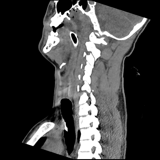 File:Atlanto-occipital dissociation (Traynelis type 1), C2 teardrop fracture, C6-7 facet joint dislocation (Radiopaedia 87655-104061 D 40).jpg