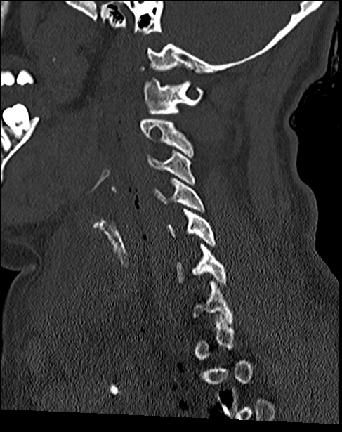 Atlanto-occipital dissociation - Traynelis type 1 (Radiopaedia 87570-103948 Sagittal bone window 56).jpg