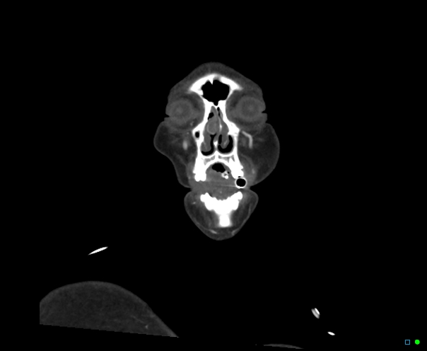 Atlanto-occipital dissociation - Traynelis type 1 (Radiopaedia 87570-103949 B 1).jpg