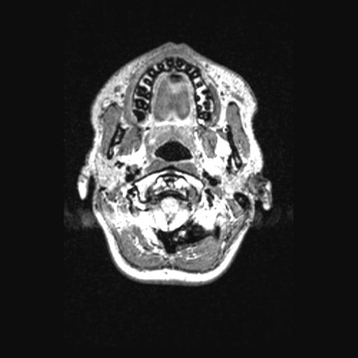 Atretic encephalocoele with inferior vermis hypoplasia (Radiopaedia 30443-31108 Axial 16).jpg