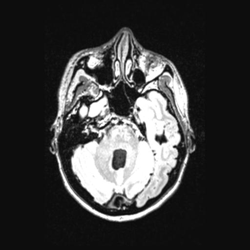 Atretic encephalocoele with inferior vermis hypoplasia (Radiopaedia 30443-31108 Axial 49).jpg