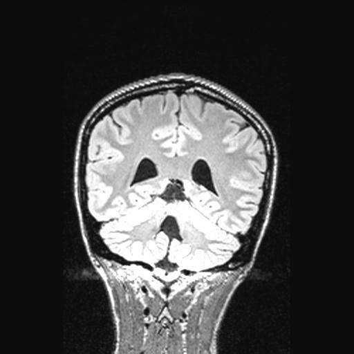 Atretic encephalocoele with inferior vermis hypoplasia (Radiopaedia 30443-31108 Coronal FLAIR 65).jpg