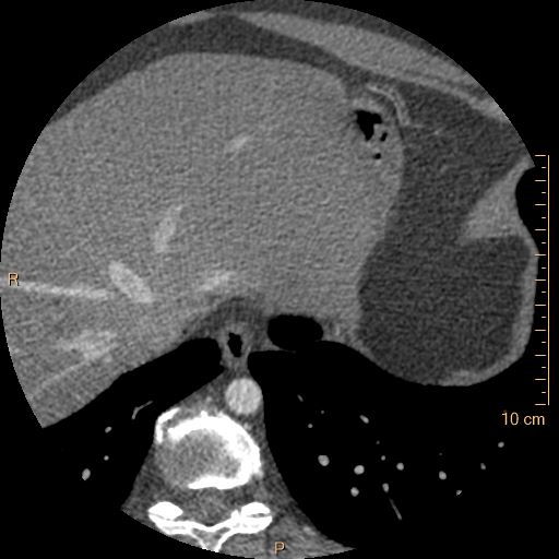 File:Atrial septal defect (upper sinus venosus type) with partial anomalous pulmonary venous return into superior vena cava (Radiopaedia 73228-83961 A 268).jpg
