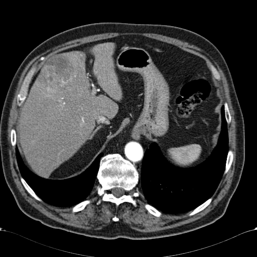 Atypical hepatocellular carcinoma (Radiopaedia 41744-44698 A 21).jpg