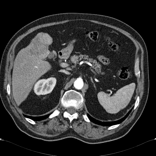 Atypical hepatocellular carcinoma (Radiopaedia 41744-44698 A 33).jpg