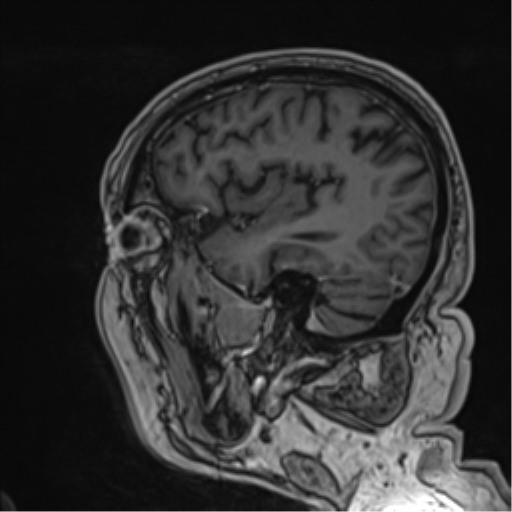 Atypical meningioma (WHO grade II) with brain invasion (Radiopaedia 57767-64729 Sagittal T1 C+ 22).png