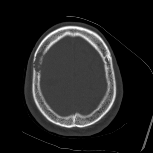 Atypical meningioma (WHO grade II) with osseous invasion (Radiopaedia 53654-59715 Axial bone window 68).png