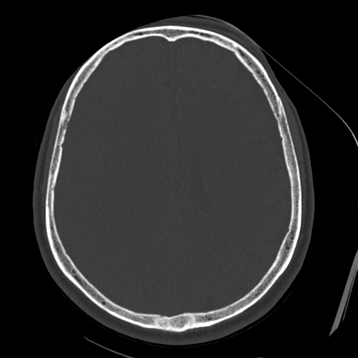 File:Atypical meningioma with skull invasion (Radiopaedia 34357-35649 Axial bone window 52).png