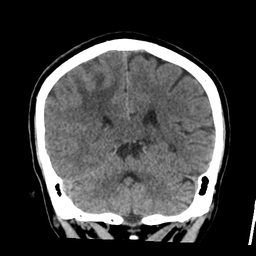 Atypical meningioma with skull invasion (Radiopaedia 34357-35649 Coronal non-contrast 43).png