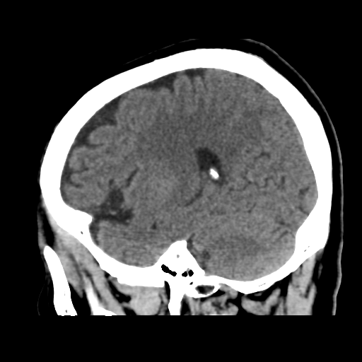 Atypical meningioma with skull invasion (Radiopaedia 34357-35649 E 38).png