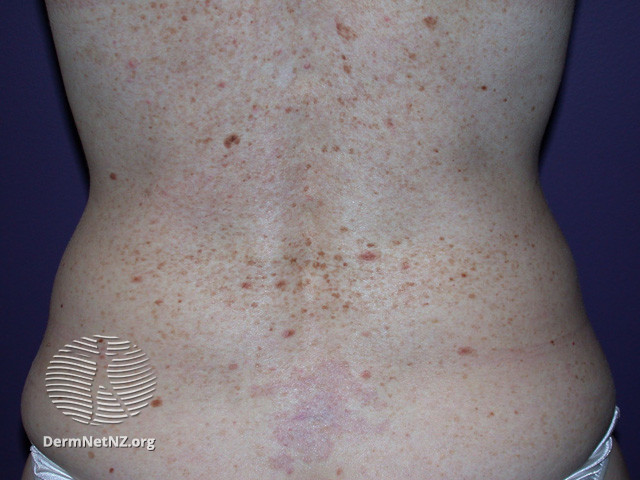 File:Atypical naevi (DermNet NZ lesions-atypical-naevi-577).jpg