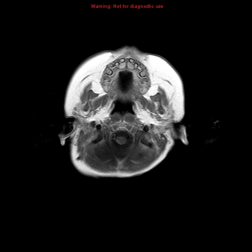 File:Atypical teratoid rhabdoid tumor (Radiopaedia 10712-11183 Axial T1 C+ 17).jpg