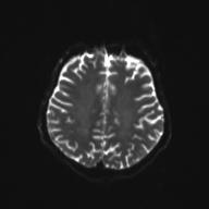 File:Autoimmune limbic encephalitis (Radiopaedia 30363-31005 Axial B0 and DWI 23).jpg