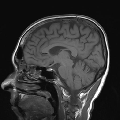 File:Autoimmune limbic encephalitis (Radiopaedia 30363-31005 Sagittal T1 14).jpg