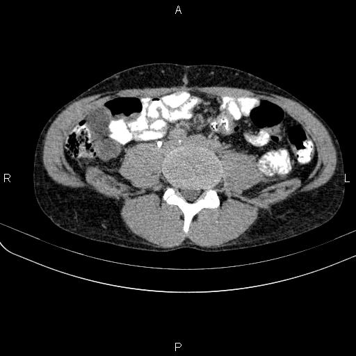 Autoimmune pancreatitis (Radiopaedia 84925-100431 Axial C+ delayed 54).jpg