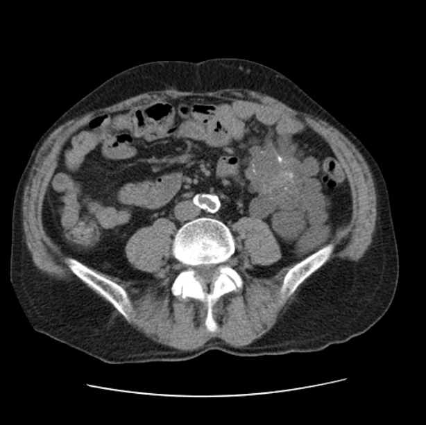 Autosomal dominant polycystic kidney disease (Radiopaedia 27851-28094 Axial non-contrast 83).jpg