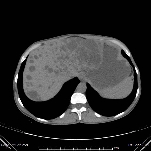 Autosomal dominant polycystic kidney disease (Radiopaedia 44122-47684 Axial non-contrast 8).jpg