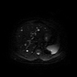 File:Autosomal dominant polycystic kidney disease (Radiopaedia 50259-55611 Axial DWI 12).jpg