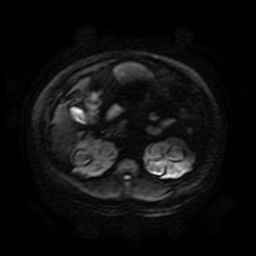 File:Autosomal dominant polycystic kidney disease (Radiopaedia 50259-55611 Axial DWI 91).jpg