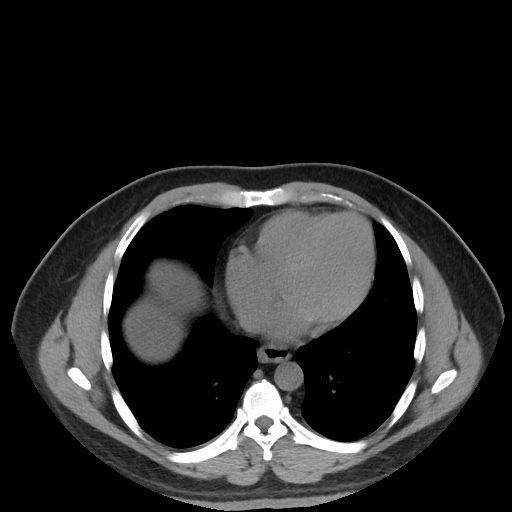 Autosomal dominant polycystic kidney disease (Radiopaedia 50259-55612 Axial non-contrast 9).jpg