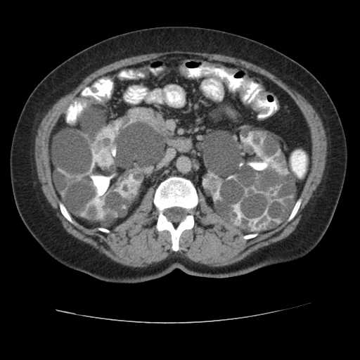 Autosomal dominant polycystic kidney disease with hepatic involvement (Radiopaedia 32693-33662 C 34).jpg