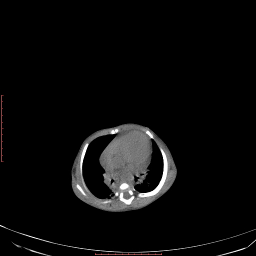 Autosomal recessive polycystic kidney disease associated with Caroli disease (Radiopaedia 61932-69984 Axial non-contrast 60).jpg