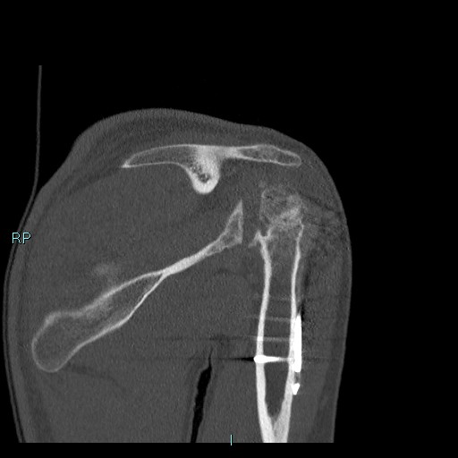 Avascular necrosis after fracture dislocations of the proximal humerus (Radiopaedia 88078-104655 Coronal bone window 63).jpg