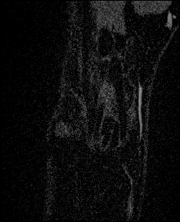 Avascular necrosis of the capitate (Radiopaedia 88317-104948 Coronal T1 vibe 7).jpg