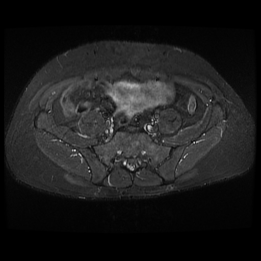 File:Avascular necrosis of the hip (Radiopaedia 61503-69465 Axial STIR 1).jpg