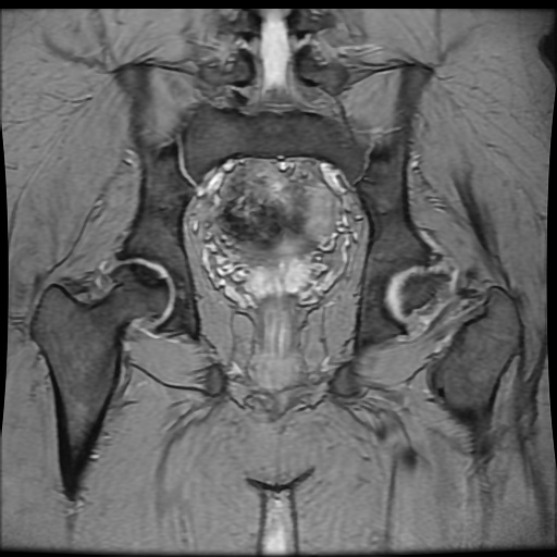 Avascular necrosis of the hip (Radiopaedia 61503-69465 F 63).jpg