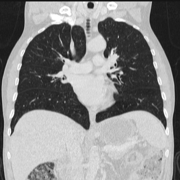 Azygos lobe (Radiopaedia 38259-40275 Coronal lung window 40).jpg