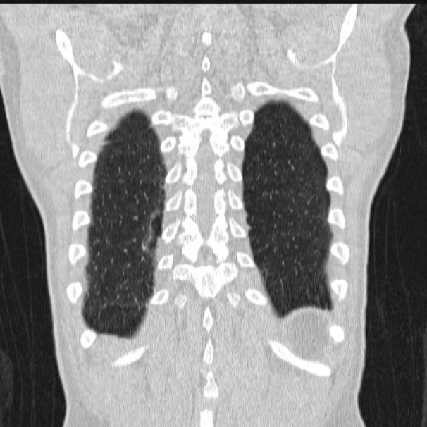 Azygos lobe (Radiopaedia 38259-40275 Coronal lung window 68).jpg