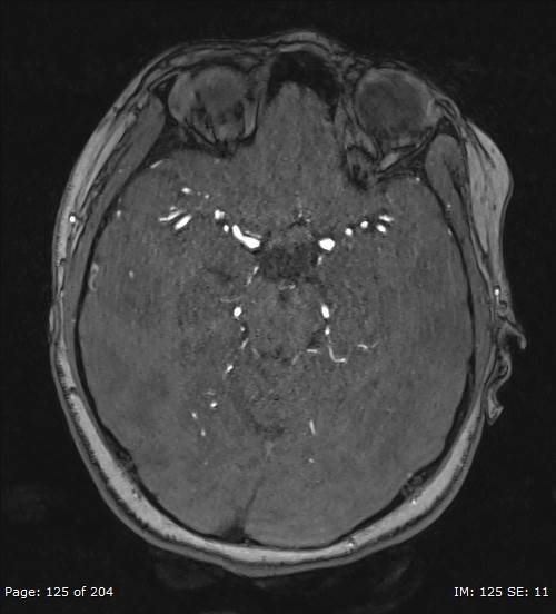 Balo concentric sclerosis (Radiopaedia 61637-69636 Axial MRA 125).jpg