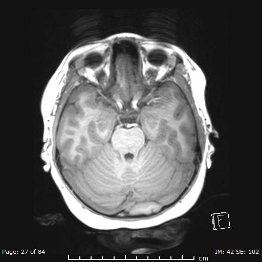 File:Balo concentric sclerosis (Radiopaedia 61637-69636 Axial T1 27).jpg